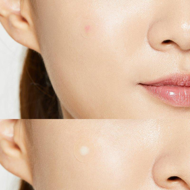 COSRX Acne Pimple Master Patch 24 Patches at Embé Skin Korean and Japanese Beauty Skincare